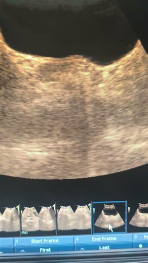 liver kidney pancreas gb spleen uterus #ytshorts#pregnant #yt #pregnant