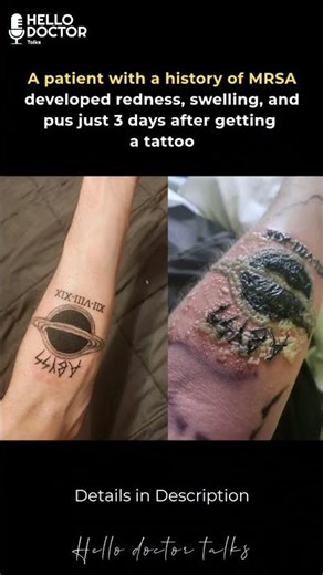 A patient with a history of MRSA developed redness, swelling, and pus just 3 days after a tattoo