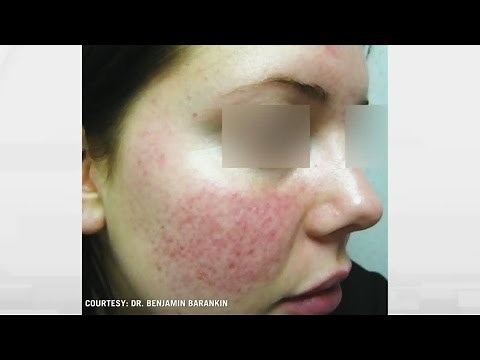 Rosacea relief: How to treat persistent facial flushing