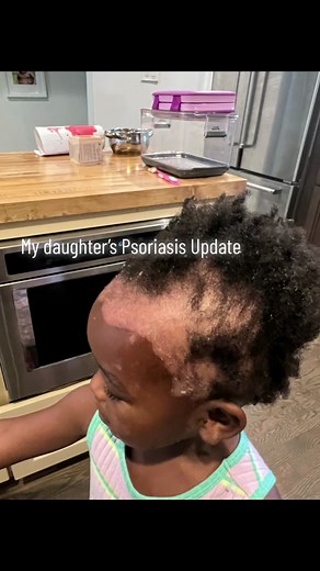 Healing Psoriasis Naturally: Gluten and Dairy-Free Diet Tips