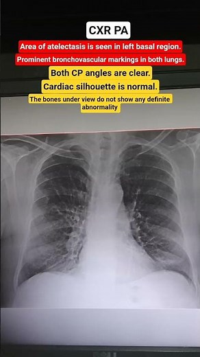 Area of atelectasis is seen in left basal region #xray