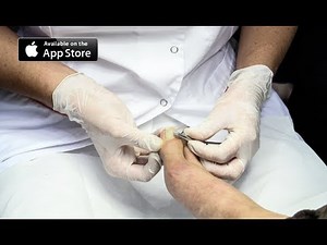 Ingrown Toenail Removal Surgery