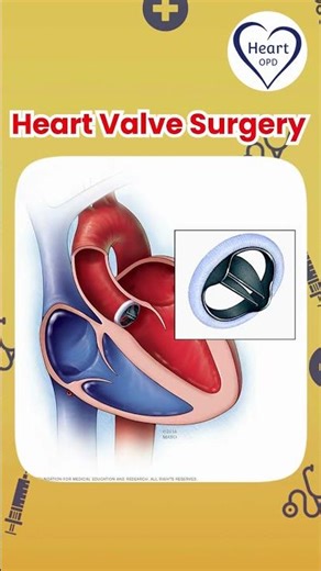 Types of Heart Surgeries Explained in Seconds 🫀 | Dr. Ebrahim Patel | Cardiologist #shorts