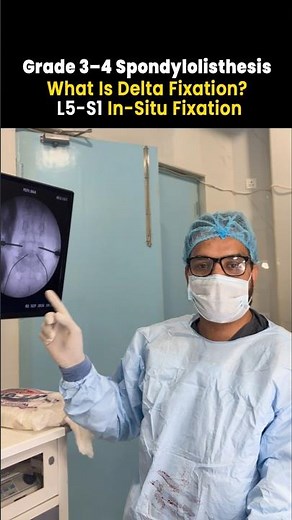 Grade 3–4 Spondylolisthesis: What Is Delta Fixation? | L5-S1 In-Situ Fixation
