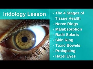 Iridology Lesson - All The Basics! (Nerve Rings, Malabsorption, Prolapsing)