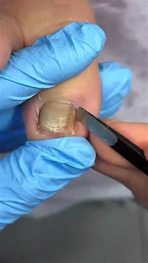 #SelfCareFeet #ToenailCareTips #Foryoupage #FYPシ #PedicureTips #ReelMagic, #FootWellness #ToeCareRoutine #SatisfyingToenailCare #HealthyToes #FootCareRoutine #FYPViral #ReelFeature #ReelTrend, | Toe Relief Tips | Facebook