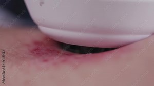 Bruise Treatment with Medical Device for Healing and Recovery.