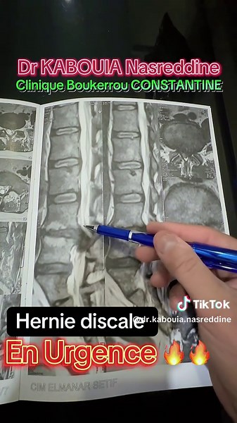 التدخل الجراحي لإنزلاق غضروفي قطني