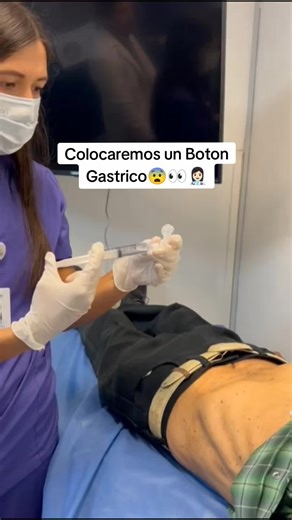 Colocación de Botón Gástrico: Procedimiento Médico