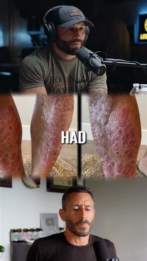 Paul Saladino, MD on Instagram: "How he healed his skin issues 🥩 Thousands of people have healed themselves of “incurable” conditions by improving the quality of their diets… Inflammation stemming from our digestive systems is likely the root cause of all diseases… As Hippocrates, the Father of Medicine, said: “All diseases begin in the gut”... The foods we eat dictate our gut health, which is why diet is the biggest lever you can pull when you are trying to heal… If you are dealing with unreso