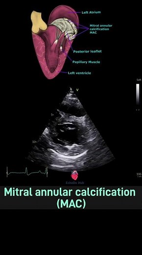 Mitral Annular Calcification (MAC) #MitralAnnularCalcification #MAC #echocardiography #2decho
