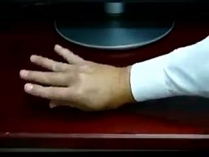 Athetosis | Jewels of Clinical Medicine