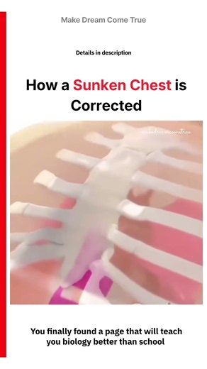 🫁 How a Sunken Chest 🛠️ is Corrected 🧑🏻‍⚕️ | MDCT