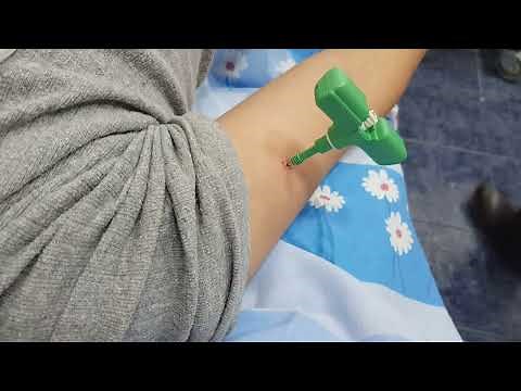 unicameral bone cyst, humerus