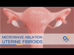 Microwave Ablation of Uterine Fibroids - Animation