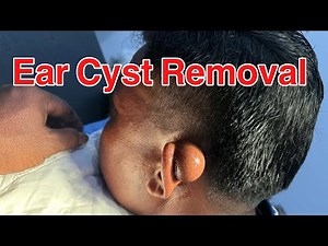 Ear Cyst Surgical Removal #Earcyst #Surgery #doctor #cyst #sebaceouscyst