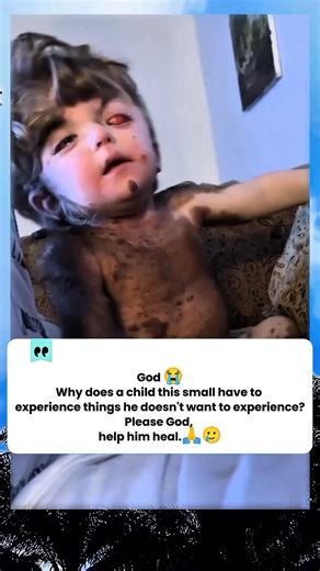 This innocent little baby has a rare congenital disorder called neurocutaneous melanocytosis (NCM). Neurocutaneous melanocytosis is a rare congenital disorder characterized by the presence of large/numerous congenital moles (congenital melanocytic nevi) on the skin, accompanied by an abnormal accumulation of melanocytes (pigment cells) in the central nervous system (brain and spinal cord). Cause: It occurs due to an embryological developmental abnormality (neuroectodermal dysplasia) during melan