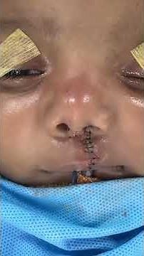 Modified Millard’s Unilateral Cheiloplasty