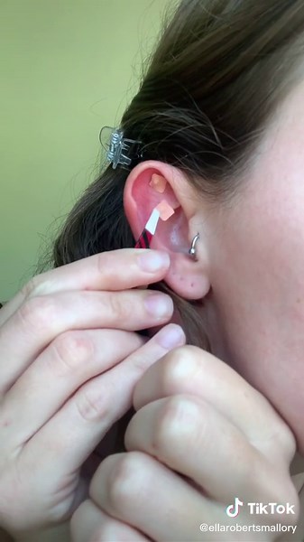 Acupuncture Ear Seeds for Pain Relief