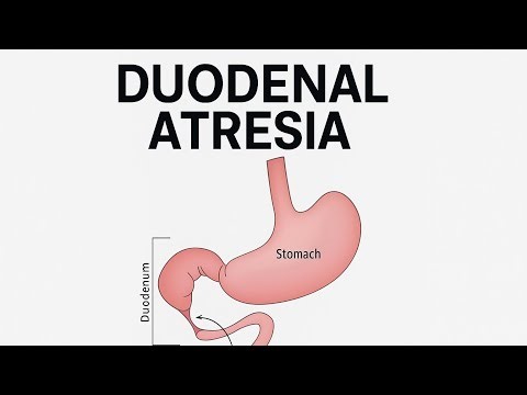 DUODENAL ATRESIA | AETIOLOGY | CLINICAL FEATURES | PATHOLOGY | TREATMENT | OUTCOME