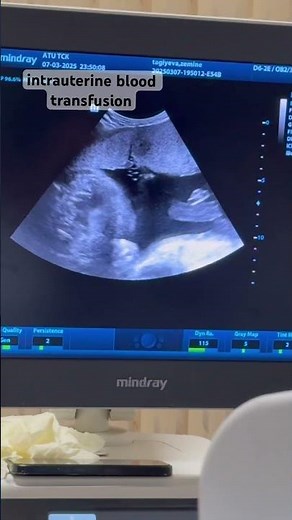 intrauterine blood transfusion