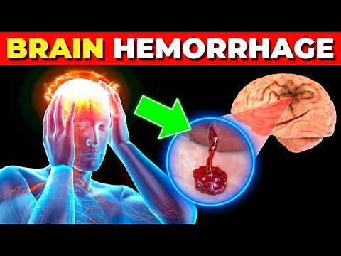 What Happens in Brain Hemorrhage? | Symptoms, Causes and Treatment