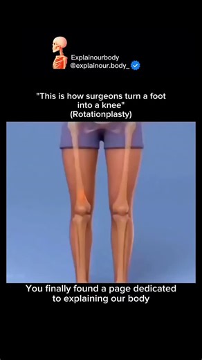 Explainourbody on Instagram: "😳 Ever wondered how surgeons can turn a foot into a knee? This jaw-dropping operation is called tationplasty — and the science behind it is unbelievable! 🦵⚡ Here’s what actually happens during the surgery: • The cancer-affected part of the leg is removed • The lower leg (with the foot) is rotated 180° • The heel becomes the new knee joint • The ankle starts moving exactly like a knee • A prosthetic attaches perfectly — allowing smooth, powerful movement It may loo