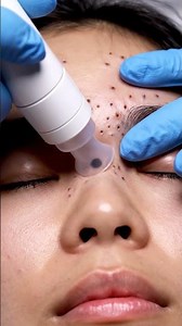 Professional Blackhead Removal with Pump Suction Machine | Relaxing ASMR 4K#045 #blackheadremoval