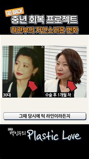 [Real-life Comparison] After Plastic Surgery in 50s vs. In 30s, Who Is the Winner? ┃ Facelift + P...
