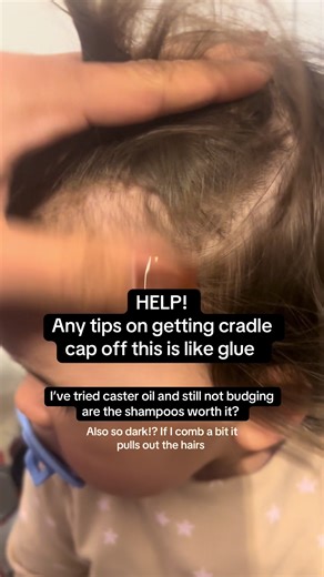 Effective Tips for Tackling Stubborn Cradle Cap