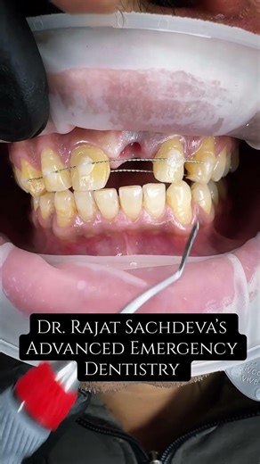 Tooth Mobility After Injury | Splinting Ka Sahi Time