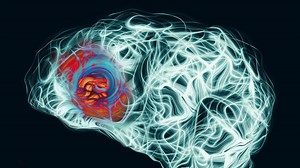 Glioblastome : définition, causes, survie, traitements