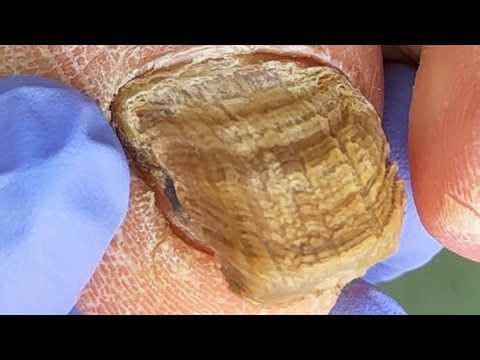 Extra Thick Bad Nails, Like Scales, Trimmed Thoroughly【Xue Yidao】