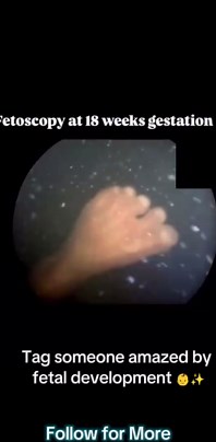 See Inside the Womb: Real Fetoscopy at 18 Weeks