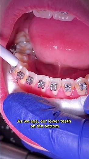 What is a permanent retainer in braces? Toothtime New Braunfels Dentist - Braces journey