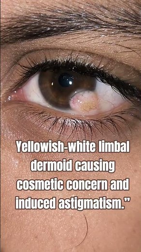 Well-defined limbal dermoid involving cornea and sclera.” #eyecare #eyecareexcellence #eyes