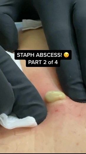 Staph abscess, part 2 of 4! 😉 #abscess #cyst #pimple #pimplepopper #pimplepopping #drmudgil