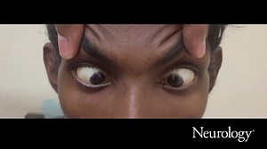 A 33-year-old man with stomach carcinoma presented with sudden-onset diplopia preceded by vomiting, anorexia, and weight loss for 3 months. He had upbeat nystagmus and mild gait ataxia. Magnetic resonance imaging showed bilateral medial thalami involvement suggesting Wernicke's encephalopathy. Learn more in the latest Neurology Video e-Pearl: https://bit.ly/3rcLhsm | Neurology Journal