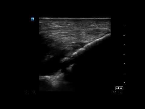 Elbow Ultrasound: Arthrocentesis