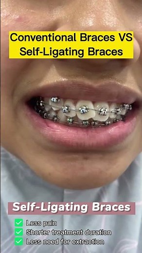 Conventional Braces vs Self-Ligating Braces - Which One Should You Choose?