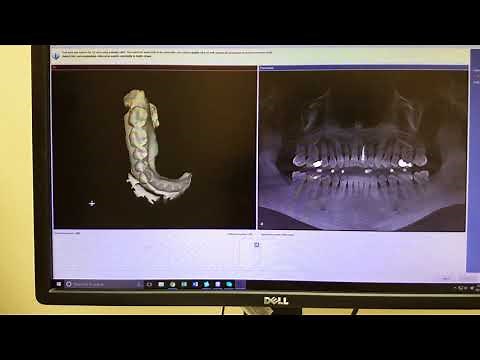 upload .ssi file from Cerec to Sidexis Galaxis for Sicat implant surgical guide