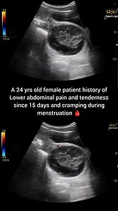 50K views · 235 reactions |  #doctor #sonologist #ultrasoundstudio #ultrasoundtech #ultrasound #medical #radiology #ultrasoundscan #hemorrhage #cyst #hemorrhagic | Ultrasound report expert | Facebook