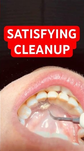 The Most Satisfying Dental Cleaning You’ll See Today ✨
