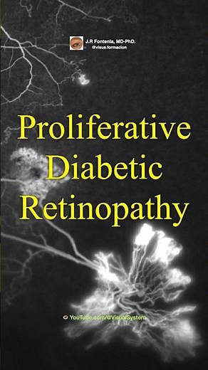 Proliferative Diabetic Retinopathy.