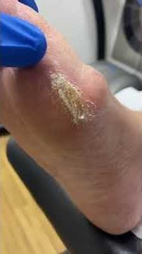 Thick Cracked Bunion Callus Removal by Australian Podiatrist | Expert Scalpel Technique