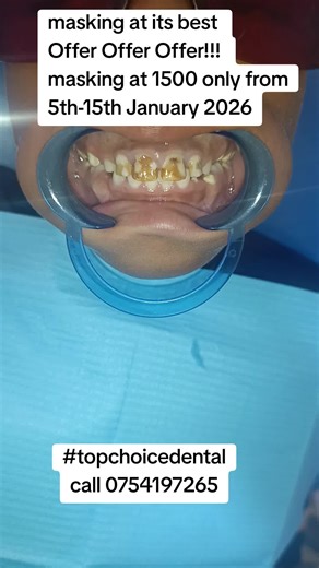 #topchoicedental #maskingoffer #dentalfillingoffers #trendingvideo #goviral
