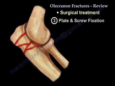 Olecranon Fractures- Everything You Need To Know - Dr. Nabil Ebraheim