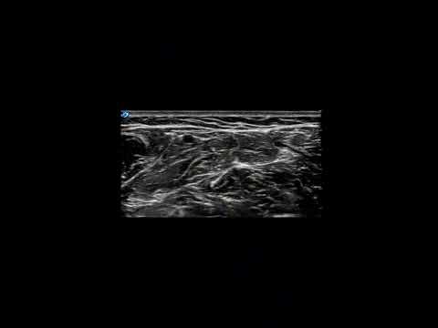 Ultrasound-Guided Forearm Blocks