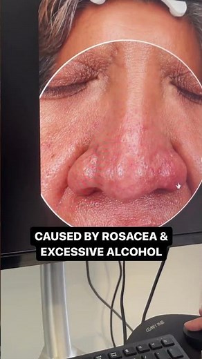 How I Treat Rhinophyma 🔥 (Reshaping Enlarged/Deformed Nose With a LASER)