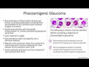 Lecture: Phacoantigenic Glaucoma (1 Slide in 5 Minutes)